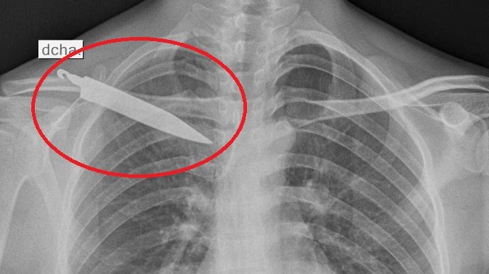 Joven tenía un cuchillo incrustado en su espalda durante un mes
