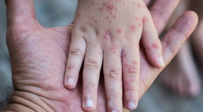 Confirman dos casos del virus de manos, pies y boca en El Tambo