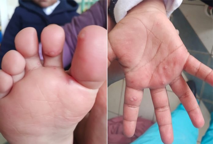 Diresa declara alerta epidemiológica por preocupante expansión del virus Coxsackie